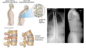 Ankylosing Spondylitis Spine osteotomy Mount Elizabeth Singapore 