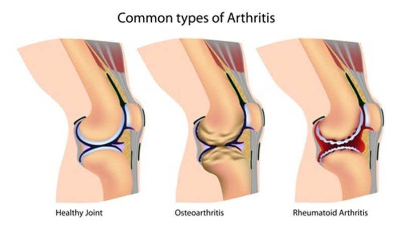 Osteoarthritis Lutut