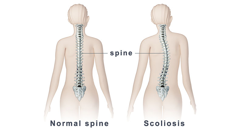 Scoliosis Spine surgery - Illustration of normal and scoliosis spine.