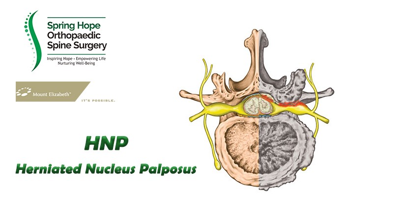 HNP (Herniated Nucleus Pulposus) 