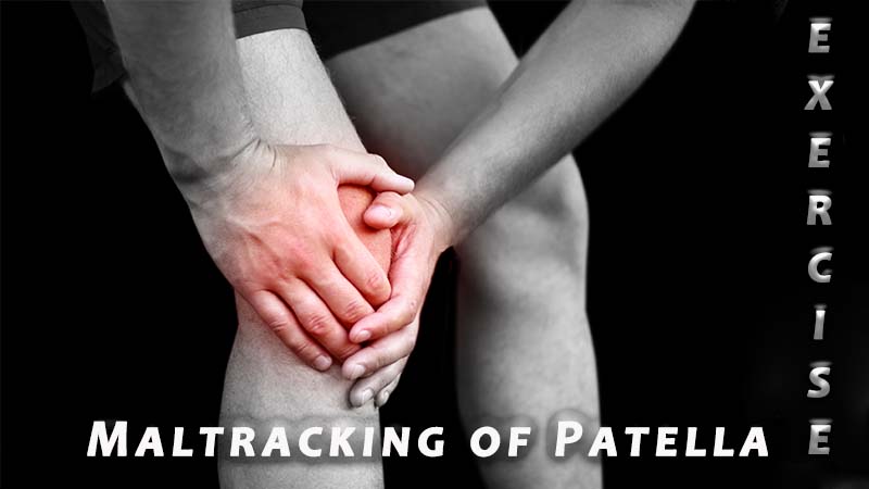 Exercises for Lateral Maltracking of the Patella 