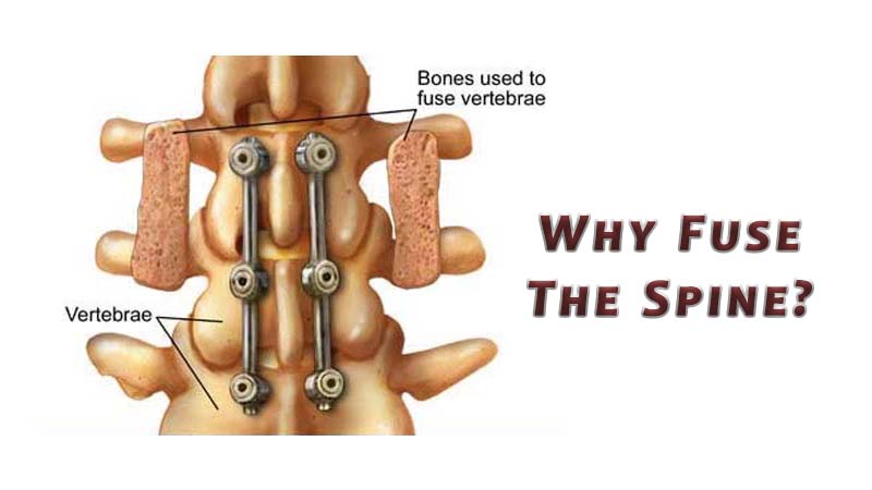 Why Fuse the Spine? 