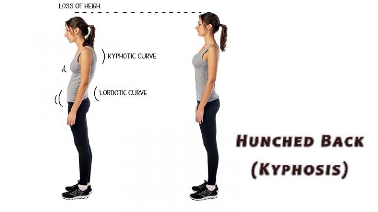 Hunched Back | Kyphosis - Orthopaedic Spine Surgery Singapore