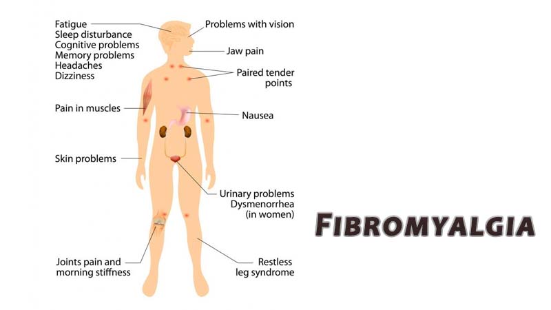 FIBROMYALGIA and its associated problems