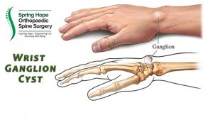 Wrist ganglion