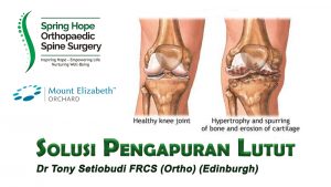 Pengapuran lutut 
