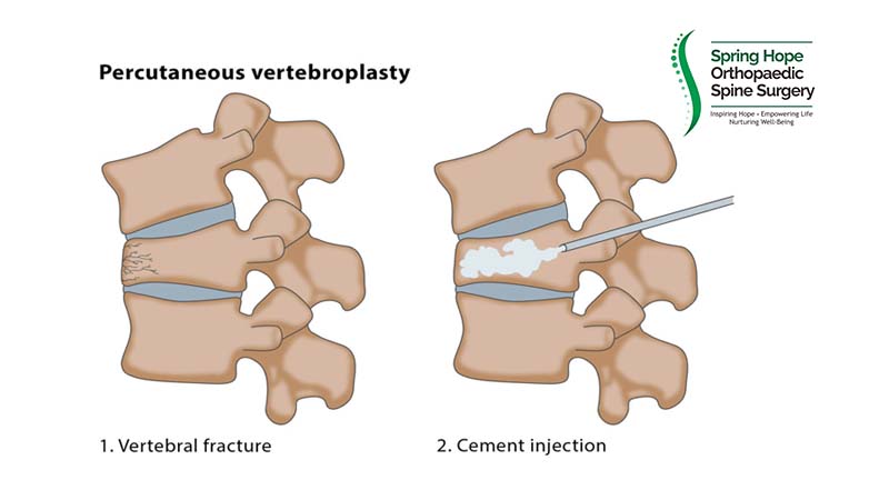 Spine fracture illustration vetebroplastasty