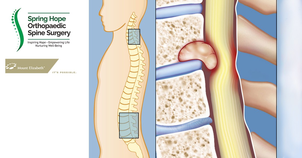 early-surgery-in-spinal-cord-compression-from-spine-tumor-gives-in