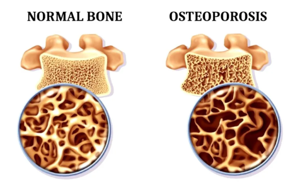 Osteoporosis Risk Check 
