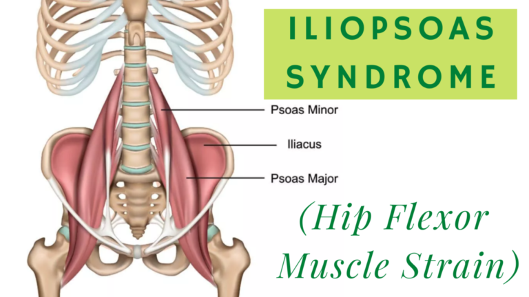 Iliopsoas Syndrome Orthopaedic Spine Surgery Singapore