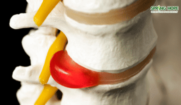 Operation to Free Up the Nerves in Spinal Stenosis