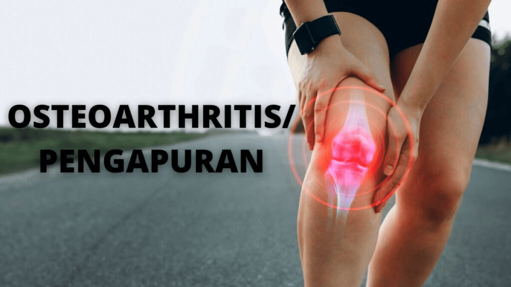 Osteoarthritis knee pain