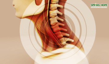 Cervical Spondylotic Radiculopathy