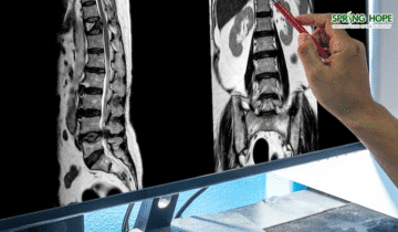 Spinal Tumor: Symptoms, Diagnosis & Orthopaedic Care
