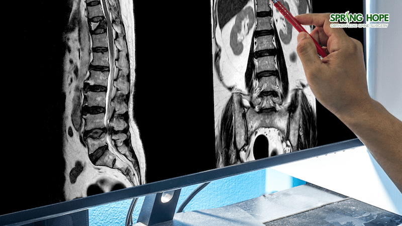 Spinal Tumor