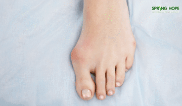 Bunions (Hallux Valgus): Causes, Symptoms, and Management