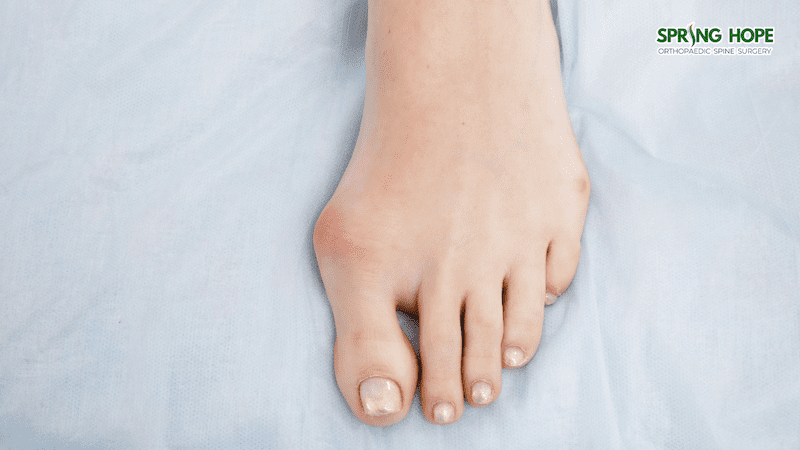 bunion